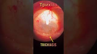 Corneal opacification and trichiasis  Помутніня рогівки і трихіаз  Помутнение роговицы и трихиаз [upl. by Ainad584]