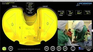 OrthoSensor VERASENSE KNEE SYSTEM Correction of Severe Varus Deformity during TKA [upl. by Zilef]