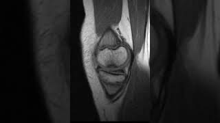 Osteochondritis dissecans of the knee [upl. by Kcirddehs121]