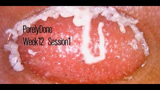 Week 12 S1 PorelyDone Pore Blackhead and Oil Vacuum Suction Removal [upl. by Rosalinda]