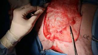 Large soft tissue sarcoma removal from the flank of a dog [upl. by Jadwiga]