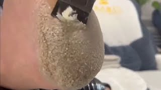 Pedicure video33，scales on the heel，vertical plantaris，plantar wart [upl. by Alvar551]