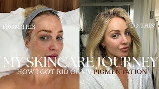 MY SKINCARE JOURNEY  HOW I GOT RID OF MY PIGMENTATION [upl. by Edlin]