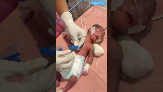 Umbilical Cord Clam Changed medical newbornbaby nicu [upl. by Sukey]