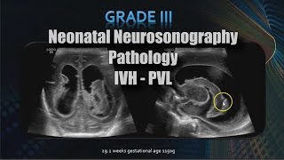 Neonatal Neurosonography  Pathology  IVH  PVL [upl. by Gittle901]