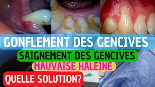 Pourquoi Vos Gencives Saignent  Causes Prévention et Traitement de la Gingivite [upl. by Eytak]