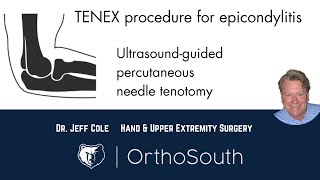 TENEX Procedure for Epicondylitis tennis and golfers elbowDr Jeff ColeOrthoSouth [upl. by Quirk738]