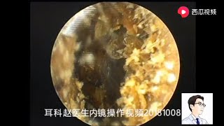 Ear wax removal Bilateral external auditory canal cholesteatoma 8 minutes 双侧外耳道胆脂瘤，8分钟 [upl. by Hax]