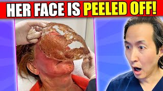 Plastic Surgeon Reacts to Face Peeling Off Videos phenol peel [upl. by Ruberta]