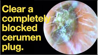 Clear a completely blocked cerumen plug ear wax removal  ear cleaning  ASMR  relaxation  relax [upl. by Rebmac364]