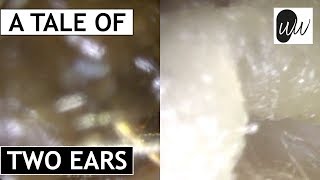 An EPIC Tale of Two Ears Bilateral Ear Wax Removal  371 [upl. by Callum893]