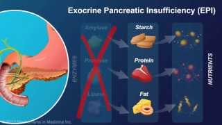 Exocrine Pancreatic Insufficiency [upl. by Hyland]