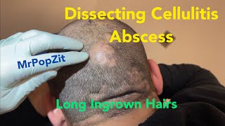 Large boggy tender mass on scalp drained that produces long ingrown hairs Incision and drainage [upl. by Launamme]