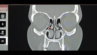 When to Operate for FESS in Chronic Bilateral Pansinusitis with Neoosteogenesis CT PNS Basics [upl. by Gard399]