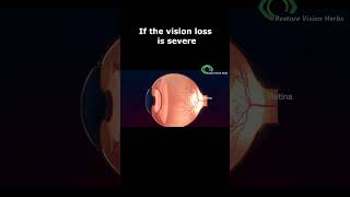 Treatment of Optic Neuritis [upl. by Ragouzis]