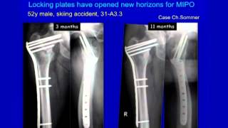 Complex Proximal Femur Fractures [upl. by Suirad]