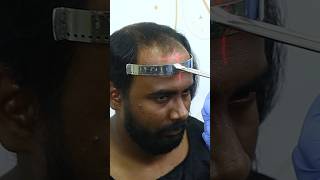 hair Transplant in kolkata [upl. by Ahsinel]