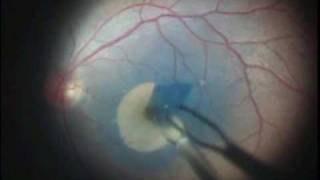 Vitrectomía con Peeling de Membrana Limitante Interna para Agujero Macular [upl. by Llertnov433]