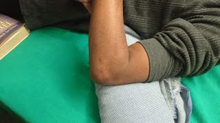 Elbow stiffness exercise [upl. by Calesta]