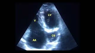 Coronary sinus mimicking a cyst to drahmadmirdamadisikTUfcNTCW7N2iR8 [upl. by Ecela]