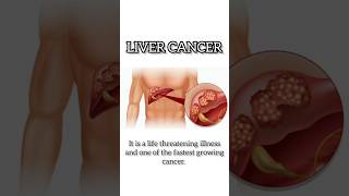 Liver Cancer I Liver cancer treatment in Delhi [upl. by Nrubliw]