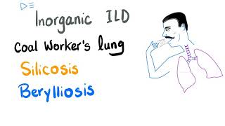 Silicosis Berylliosis amp Coal Workers Pneumoconiosis  Interstitial Pulmonary FibrosisLung Disease [upl. by Averyl822]