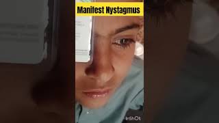 manifest Nystagmus  nystagmus eyediseases [upl. by Teemus889]