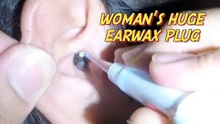 Womans Huge Earwax Plug Removed without Applying Earwax Softener [upl. by Erme488]