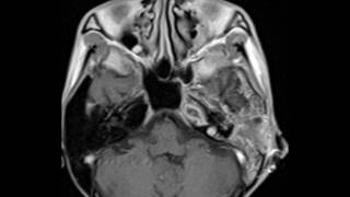 Petrous Apex Abscess [upl. by Mira908]