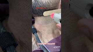 Laser Hair Removal Treatment getsmarthairclub hair viralvideo hairremoval [upl. by Hoes]