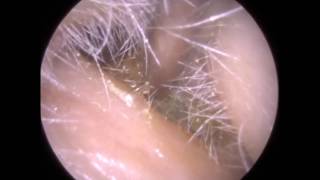 239  Extremely Narrow Ear Blocked Ear Wax Removal using Endoscopic Ear Microsuction [upl. by Sadick]