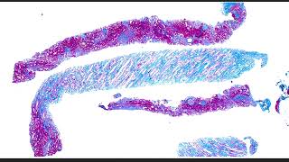 Collidescope Ep 1  What happens when IgA nephropathy and fibrillary glomerulopathy collide [upl. by Nevil558]