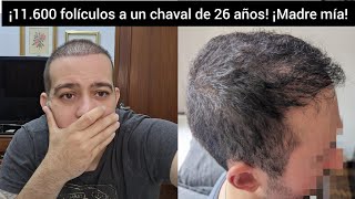 ¿MALA PRAXIS Dr Felipe Pittella 👨🏻‍🦱 JOVEN DE 24 AÑOS 😱 11600 FOLÍCULOS 😱 [upl. by Asserrac338]