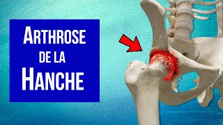 Arthrose de la hanche  Explication et Traitement [upl. by Manny]