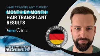 Month by Month hairtransplant Time Lapse Before After Results hairtransplantturkey 4500grafts [upl. by Laryssa515]