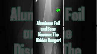 Aluminum Foil and Bone Disease The Hidden Danger [upl. by Werdna380]