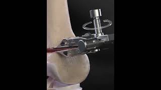 Distal Femoral Osteotomy  animationshorts shortsfeed youtubeshorts viralshorts [upl. by Baalbeer]