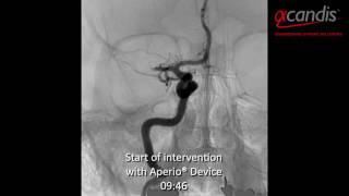 Acute ischaemic stroke treatment Acandis Aperio® Thrombectomy Device [upl. by Hite]