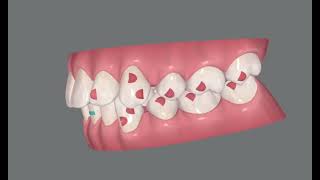 Extraction of four premolars Invisalign Clincheck case simulation [upl. by Ahsela433]