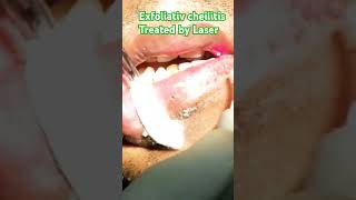 Exfoliatve cheilitis treated by Laser [upl. by Ahaelam]