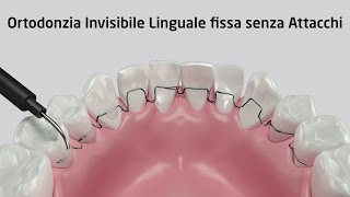 Ortodonzia Invisibile Linguale fissa senza Attacchi  Zerodonto [upl. by Poucher743]