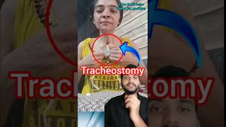 Tracheostomy shorts [upl. by Oirogerg]