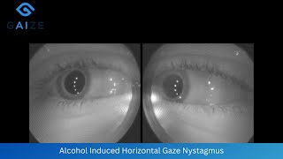 Alcohol Induced Horizontal Gaze Nystagmus at Maximum Deviation [upl. by Eneg354]