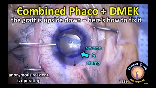 combined Phaco  DMEK surgery cataract surgery and lamellar corneal transplant [upl. by Tezil]