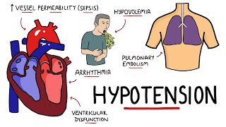 Causes of Hypotension  What causes Low Blood Pressure with Signs and Symptoms [upl. by Eadith283]