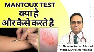 Mantoux Test क्या है और कैसे करते है  Mantoux tuberculin skin test TST TB Test  Diagnosis of TB [upl. by Agn]