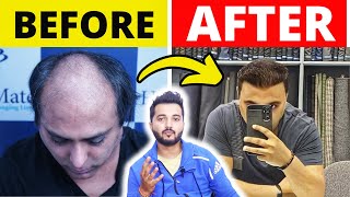 1 Year Incredible Hair Transplant Result Journey  Hair Transplant Cost In Pune [upl. by Jock287]