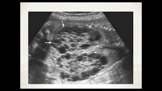 Fetal Dysplastic kidney [upl. by Anilag]