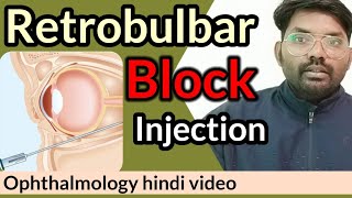 retrobulbar block injection  retrobulbar block  ophthalmologyhindi retrobulbarinjection [upl. by Aerdnod]