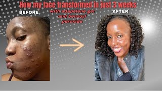 How my skin transformed in just 3 weeks of using adapalene gel and Benzoyl peroxide [upl. by Iak]